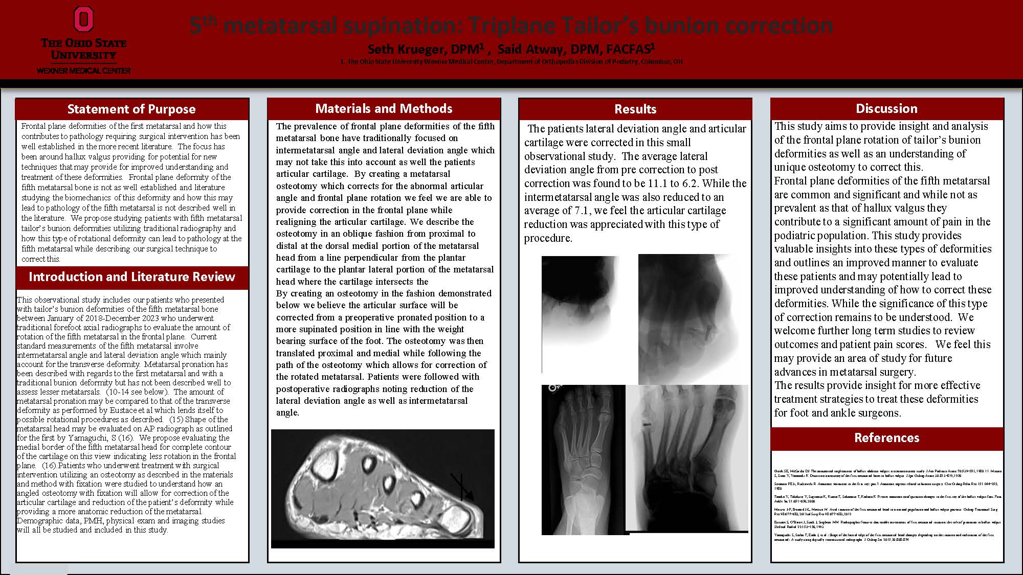 5th Metatarsal Supination: Triplane Tailor’s Bunion Correction