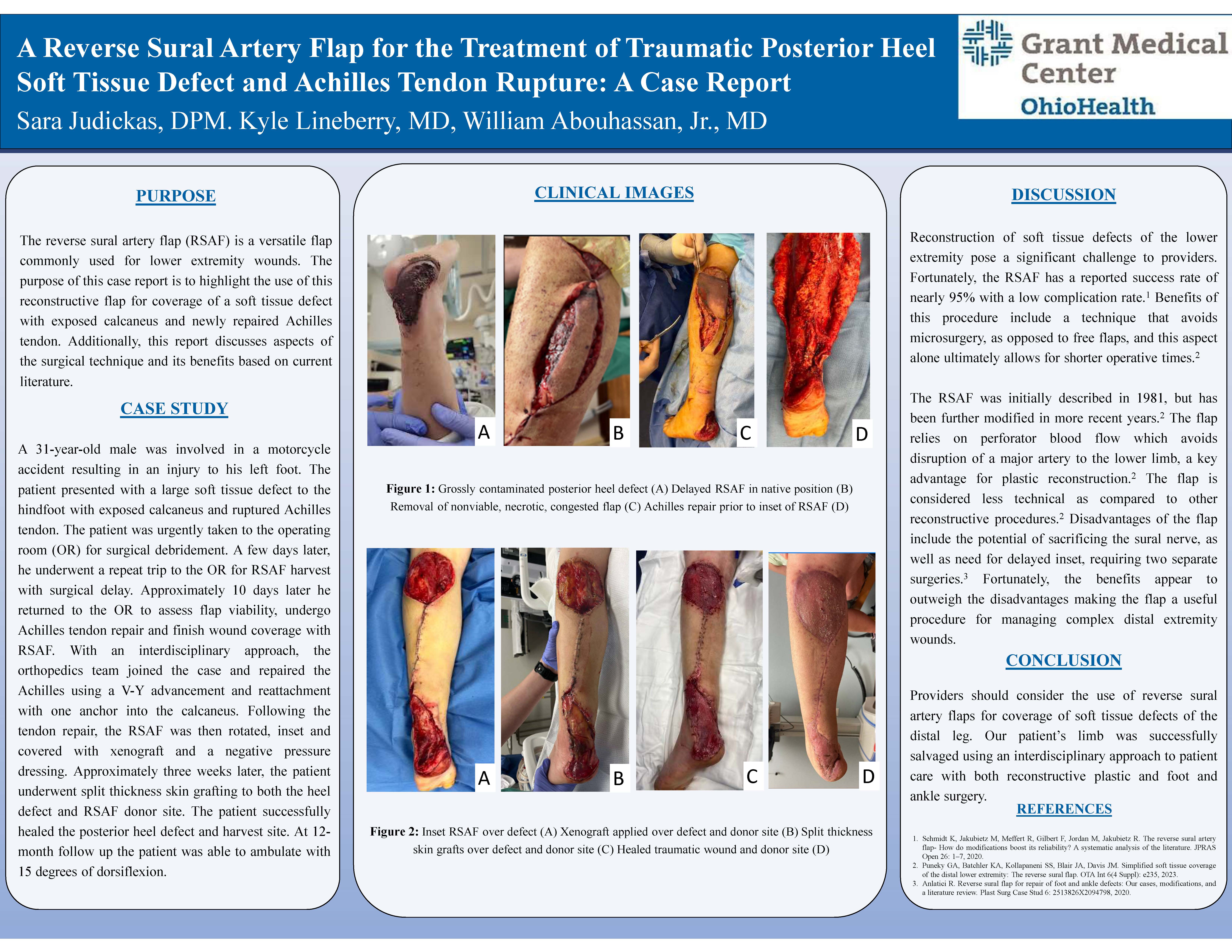 A Reverse Sural Artery Flap for the Treatment of Traumatic Posterior Heel Soft Tissue Defect and Achilles Tendon Rupture: A Case Report