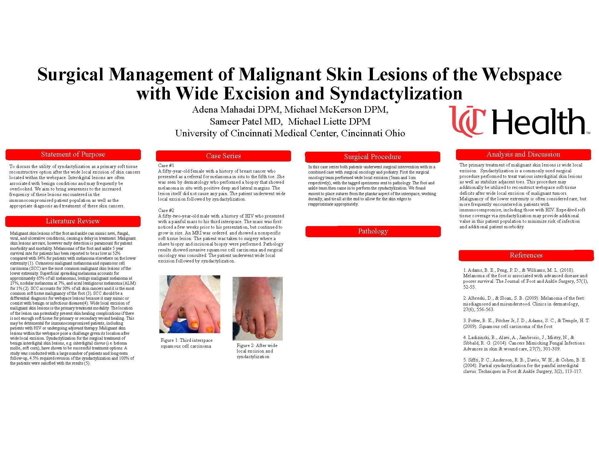 Surgical Management of Malignant Skin Lesions of the Webspace with Wide Excision and Syndactylization