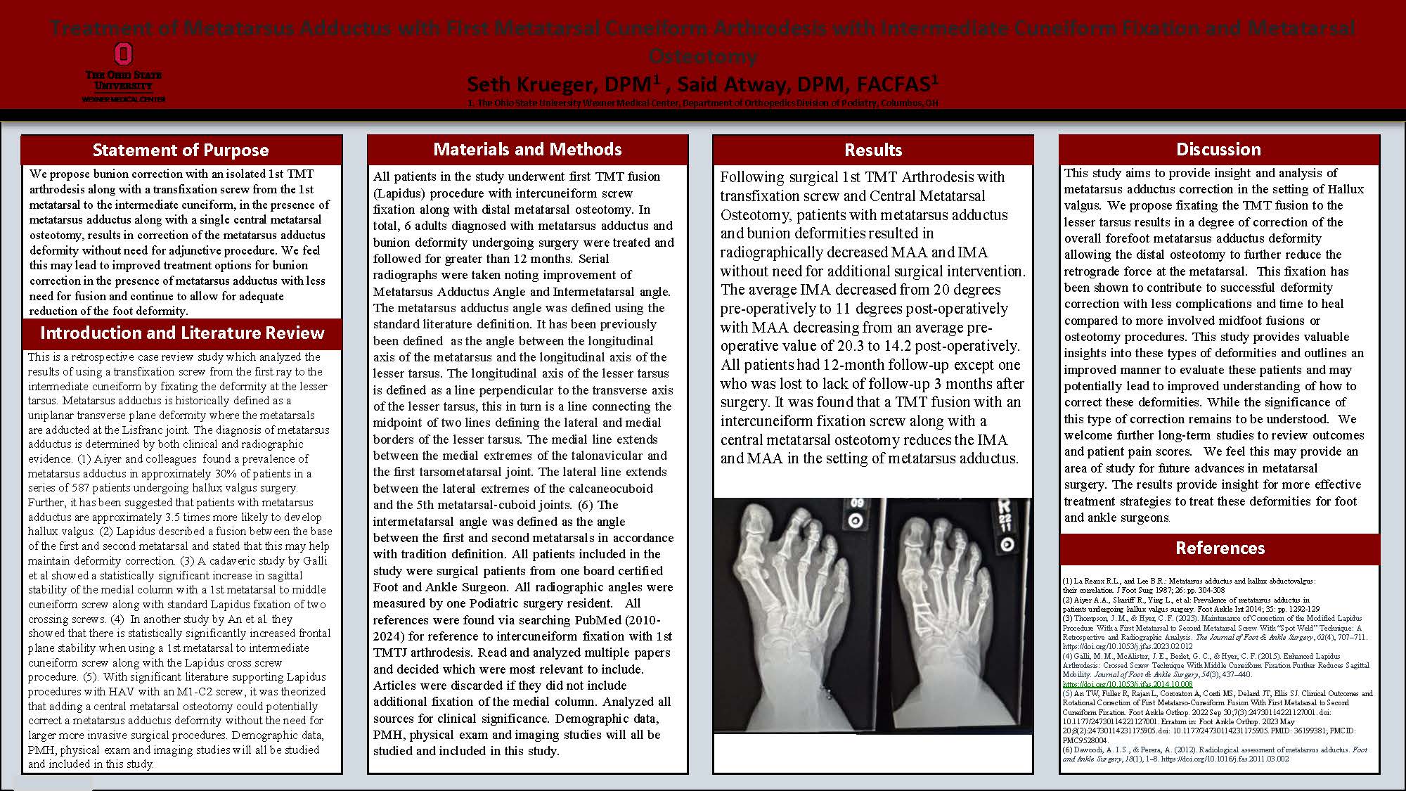 Treatment of Metatarsus Adductus with First Metatarsal Cuneiform Arthrodesis With Intermediate Cuneiform Fixation and Metatarsal Osteotomy