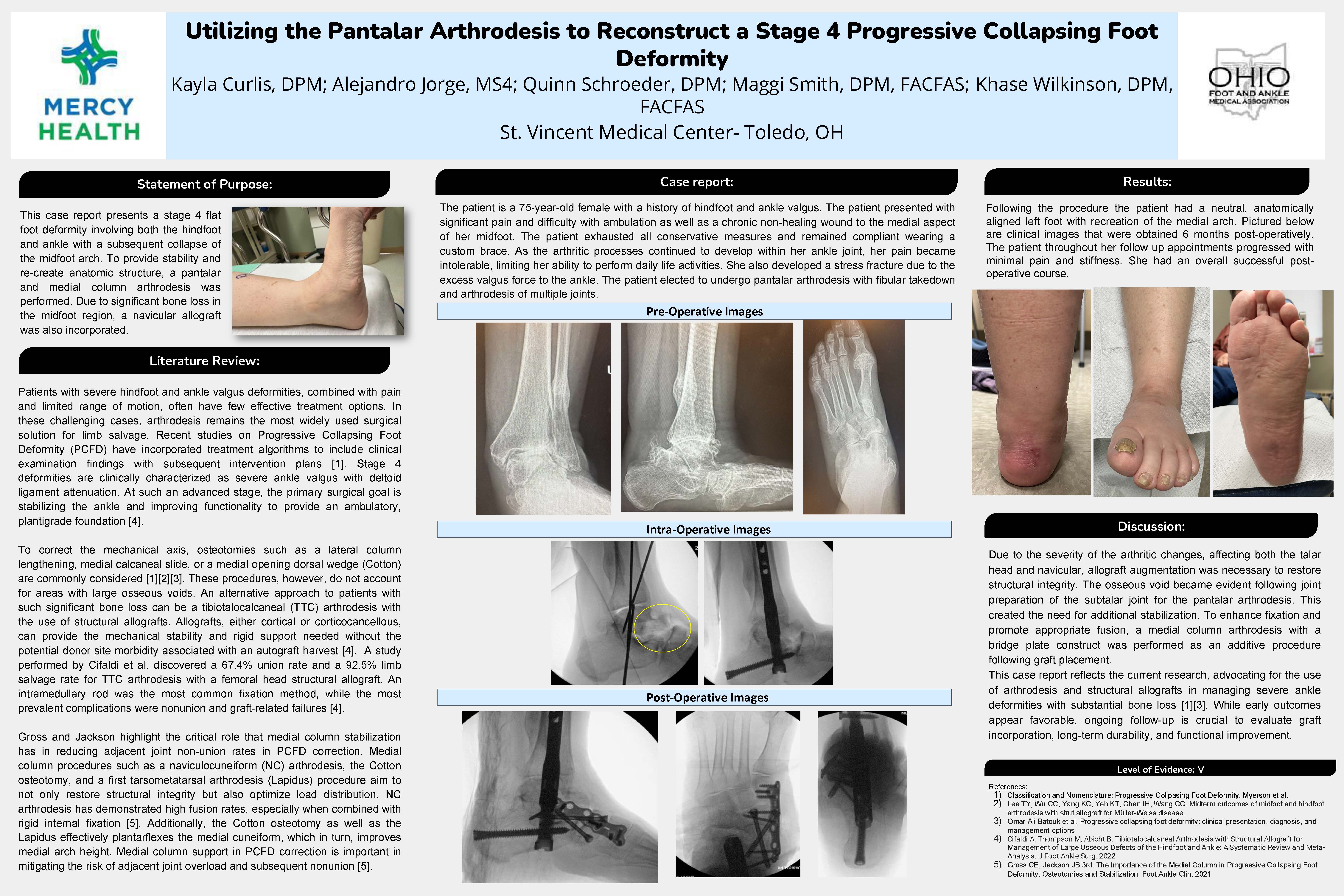 Utilizing the Pantalar Arthrodesis to Reconstruct a Stage 4 Progressive Collapsing Foot Deformity